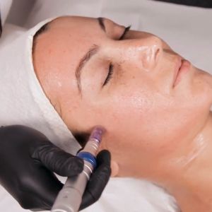 curs microneedling